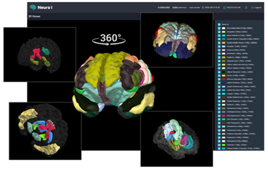 MRI 사진을 3차원 영상으로 재구성해 치매 여부를 영역별로 분석하는 치매 예측의료기기 화면. 조선대 제공